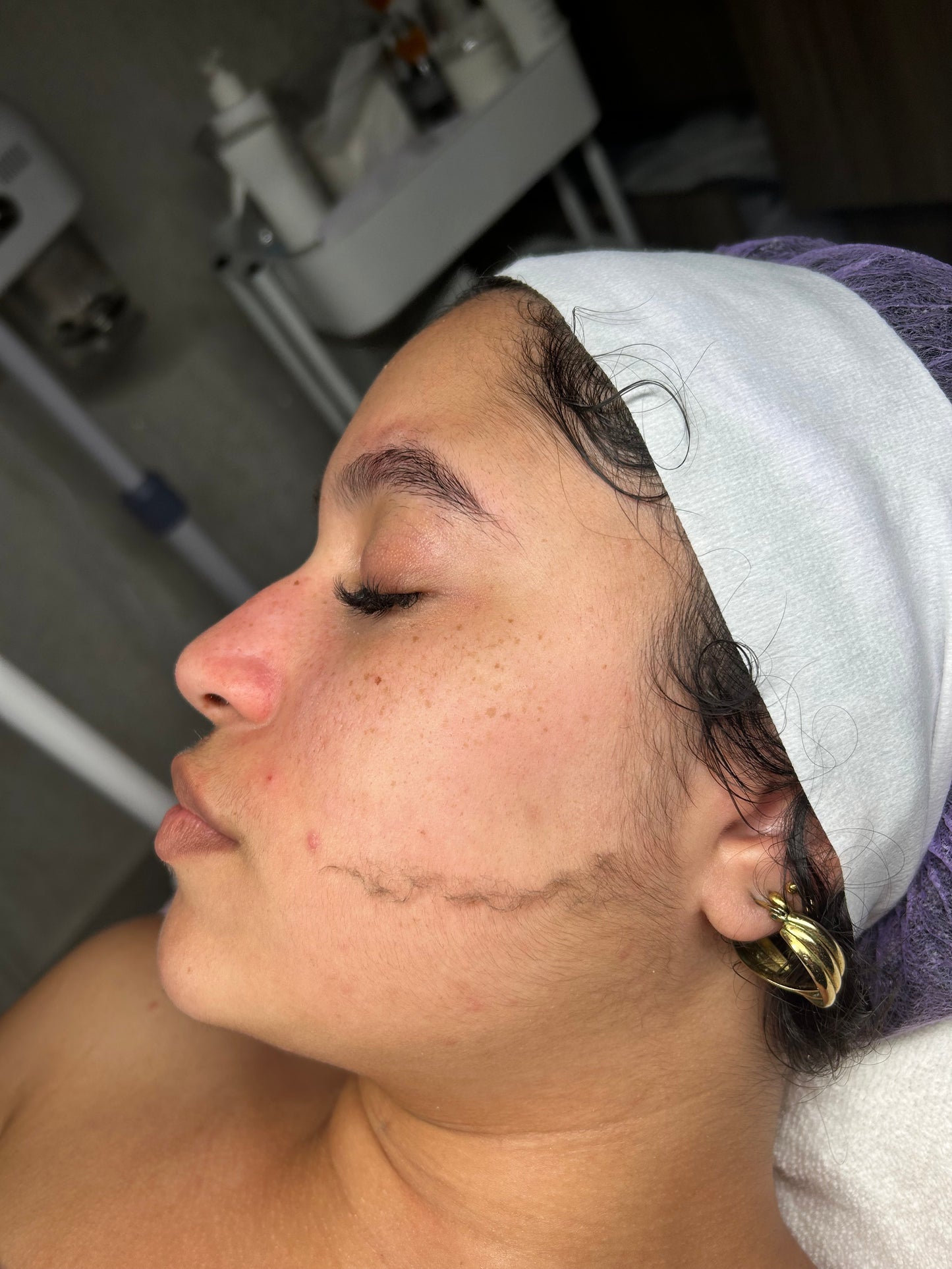Dermaplaning